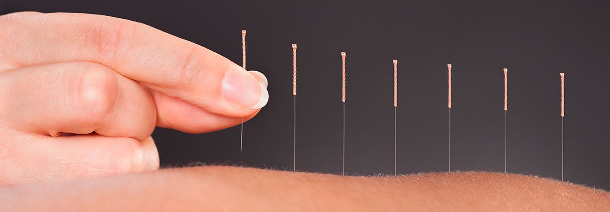 acupuntura-tres-cantos-centro-fisioterapia